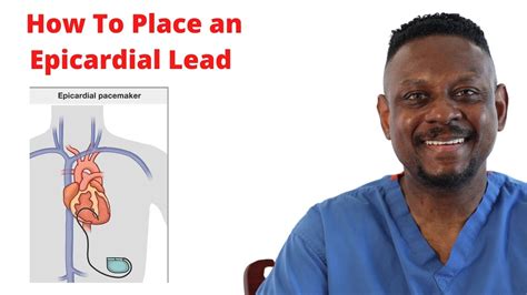 where are epicardial leads placed